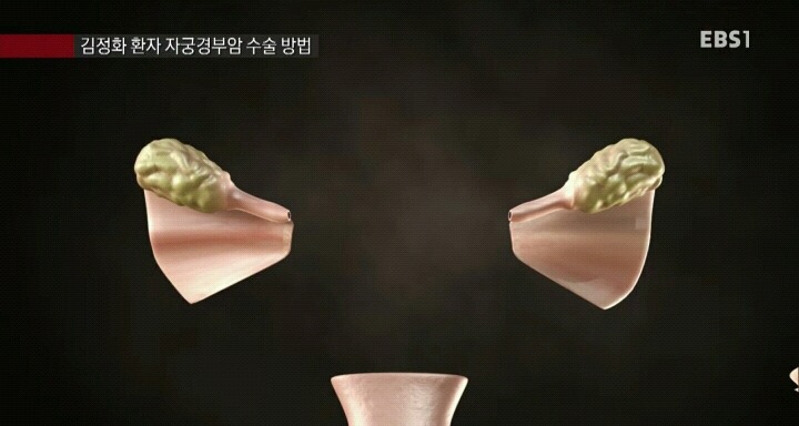 자궁경부암 수술방법.jpg | 인스티즈
