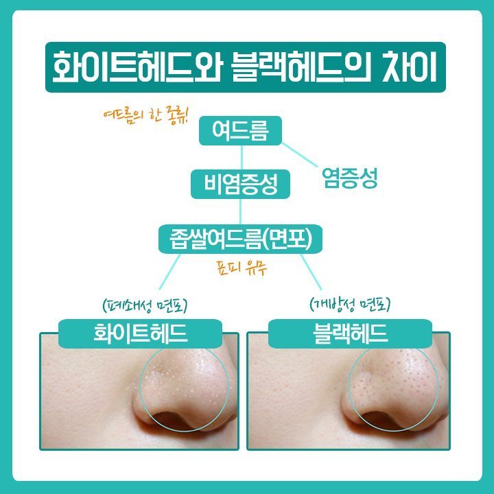 블랙헤드 제거하는 방법 5단계 | 인스티즈