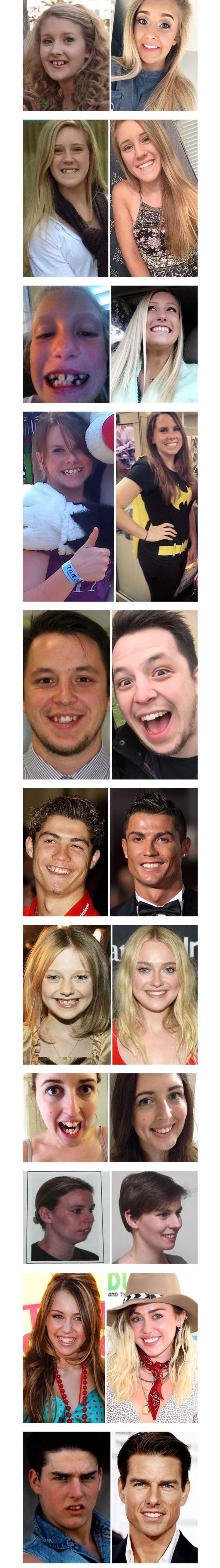 치아교정을 해야되는 이유 | 인스티즈